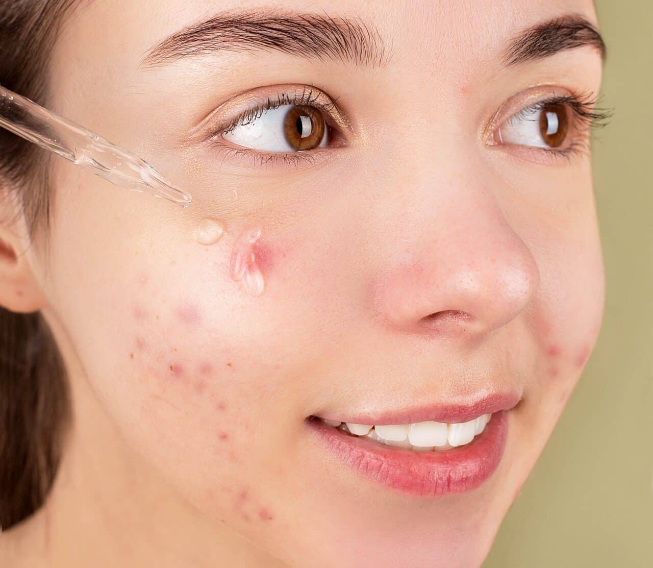 Woman applying essential oils to pimples.